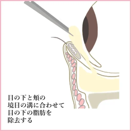 脱脂